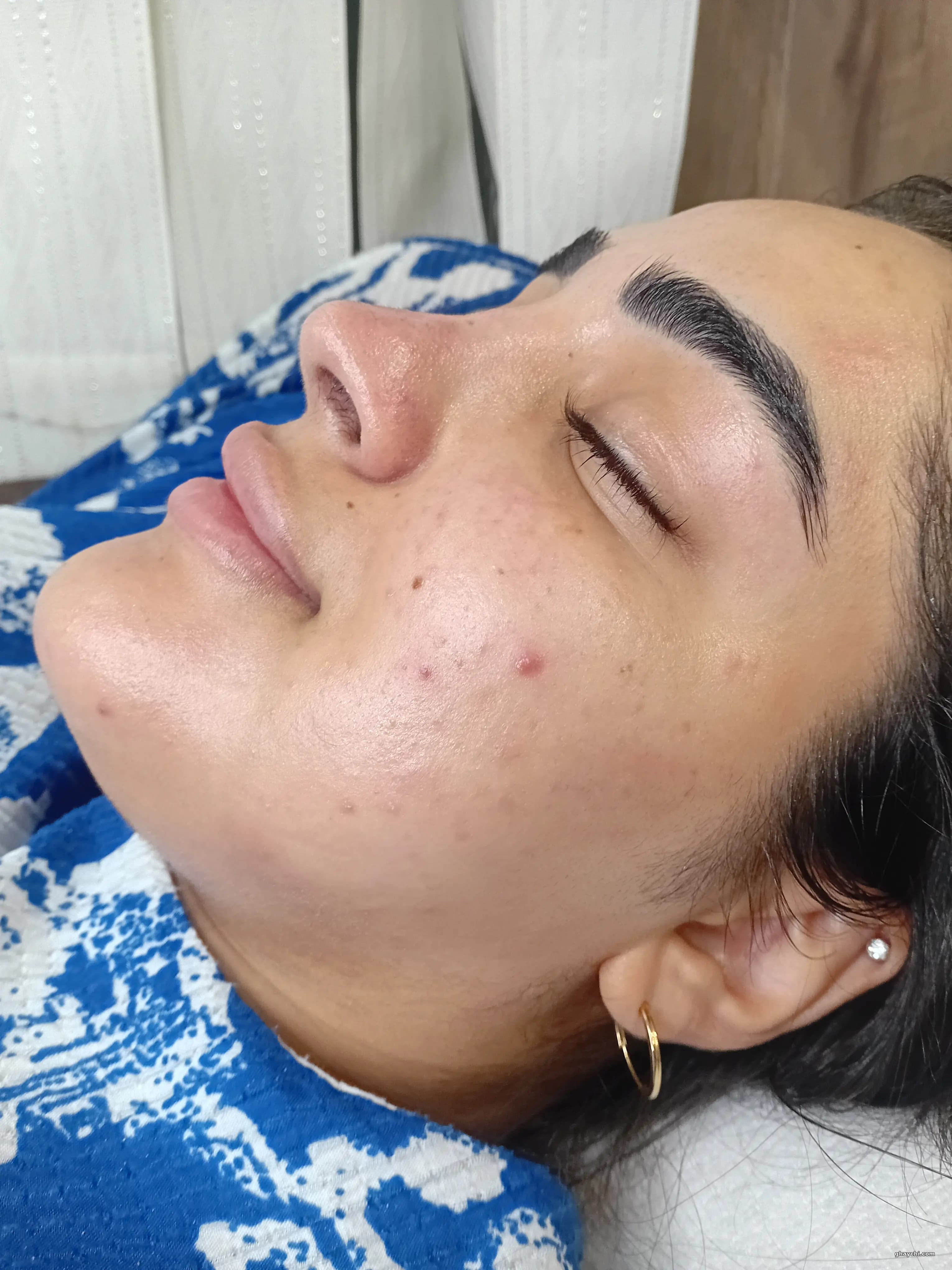 نمونه کار پوست — فیشیال صورت قبل و بعد زنانه در خانی آباد نو جنوبی، تهران — هنر