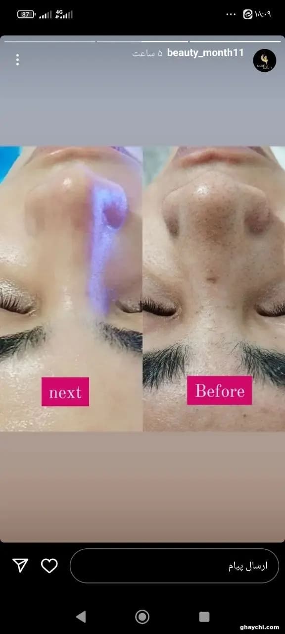 نمونه کار پوست — فیشیال صورت زنانه در قشم، قشم — مرضیه باغبانی