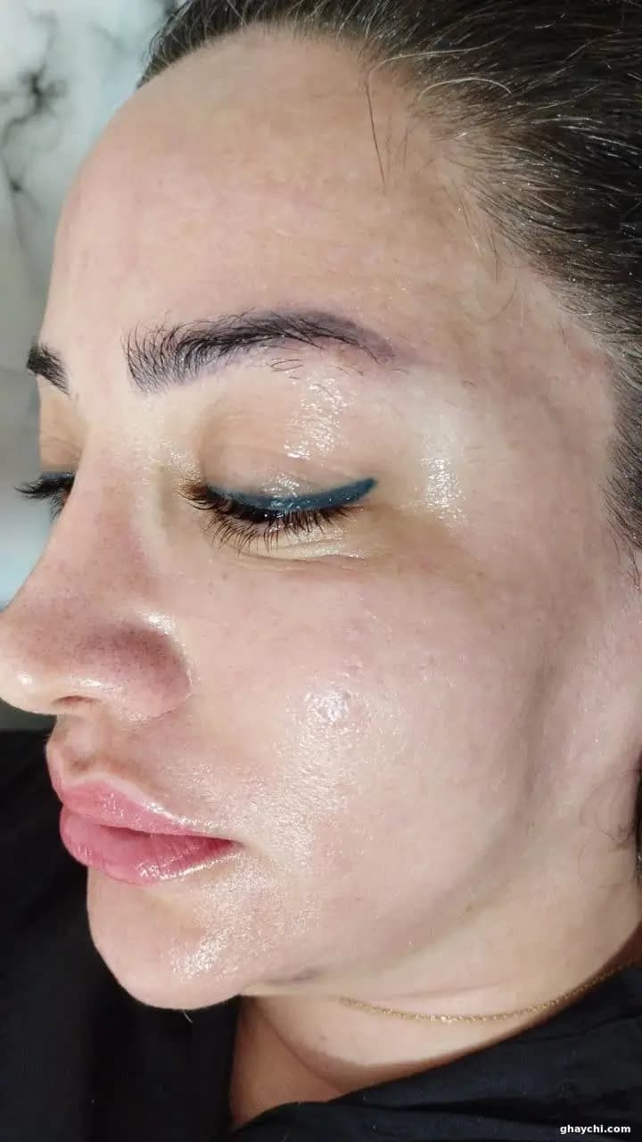 نمونه کار پوست — فیشیال صورت زنانه در سنندج، سنندج — کلینیک تخصصی پوست وموواسپا آرشا