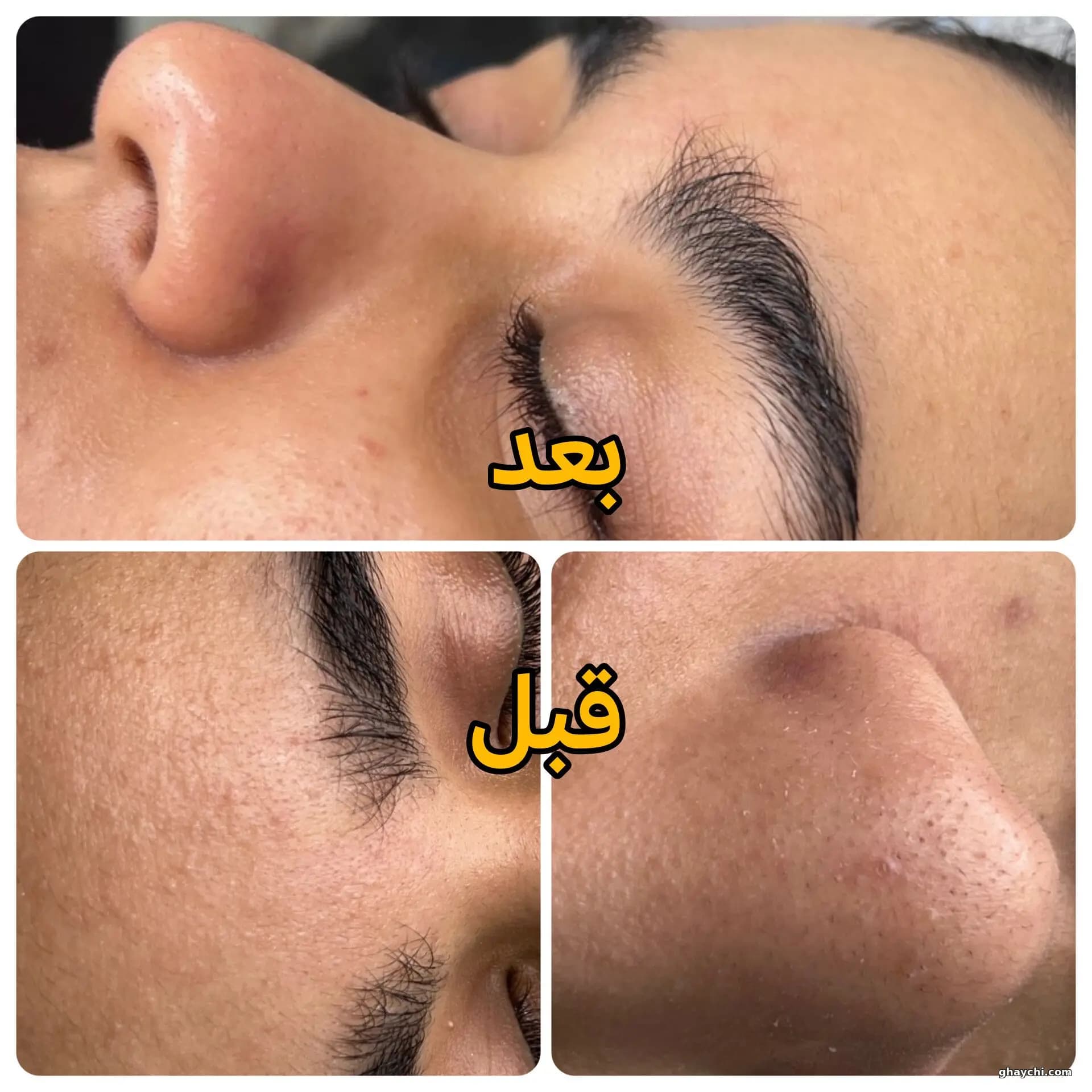 نمونه کار پوست — مزونیدلینگ پوست زنانه در قاسم آباد، مشهد — فاطمه رنجبر