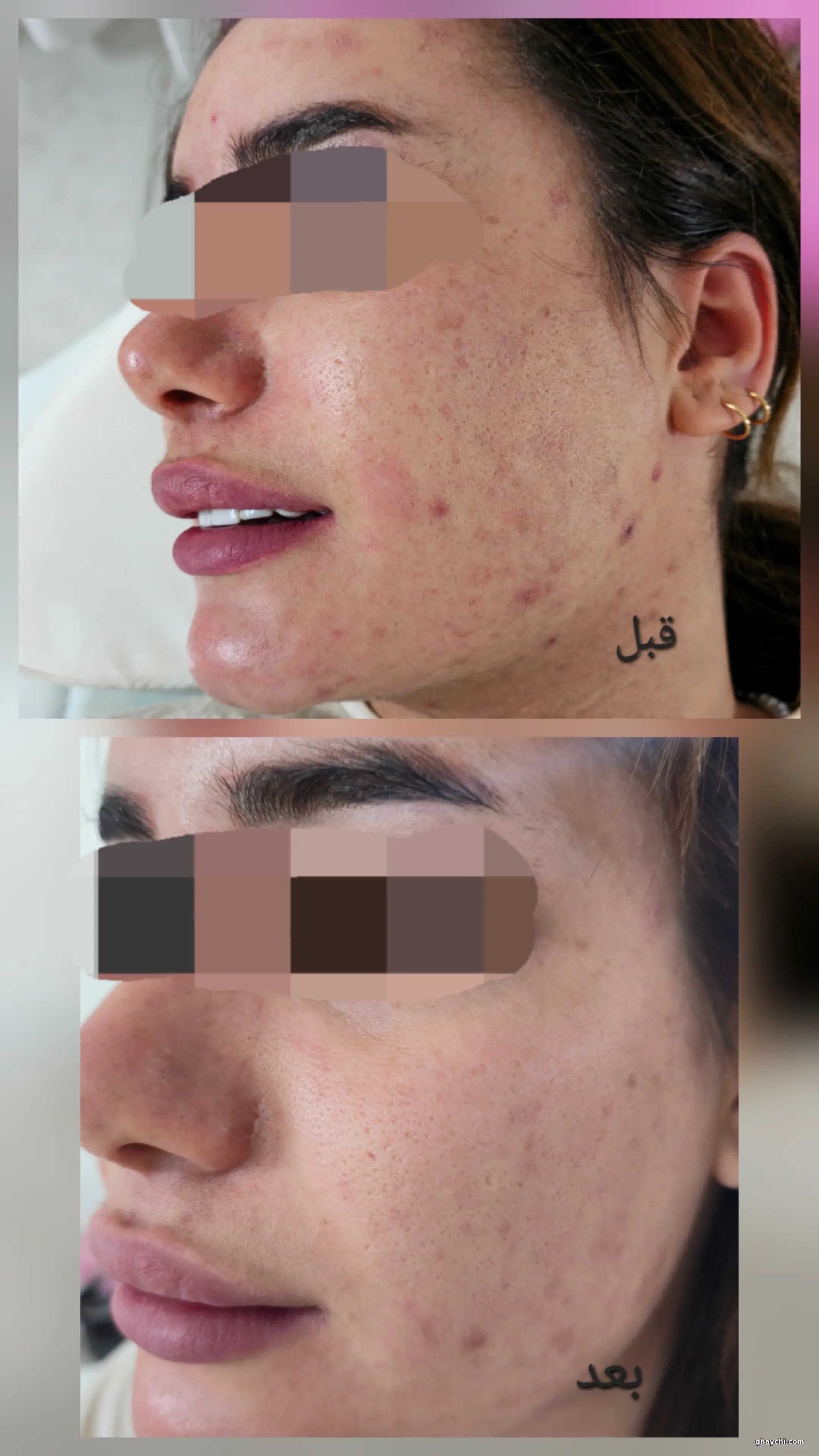 نمونه کار پوست — مراقبت از پوست لک‌دار زنانه در زنجان، زنجان — الهام شجاعی