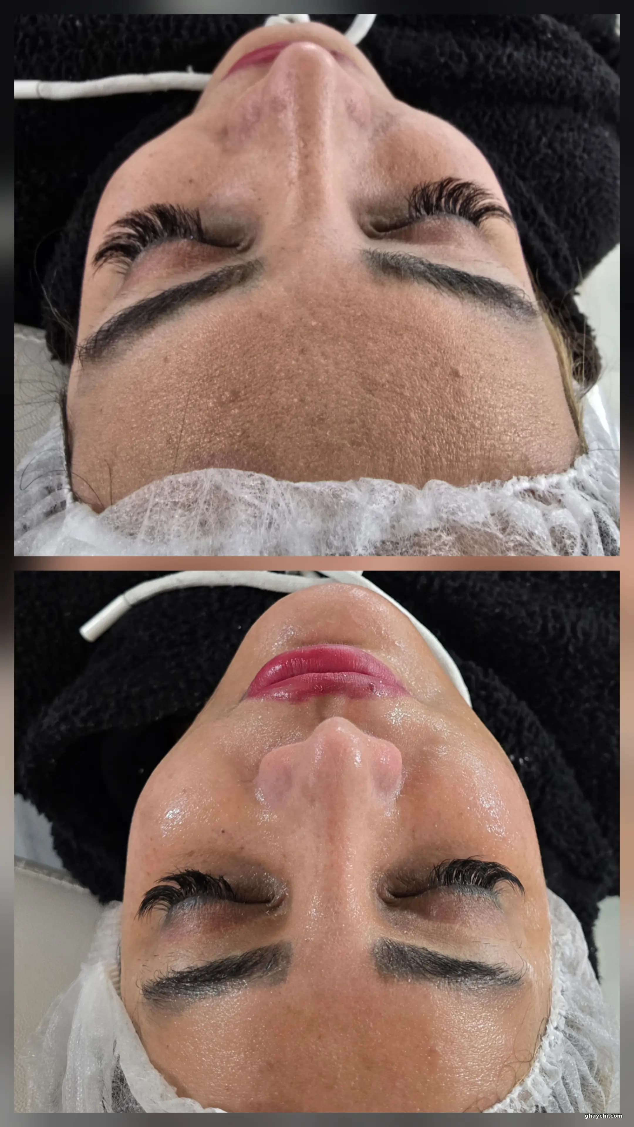 نمونه کار پوست — پاکسازی صورت زنانه در زنجان، زنجان — الهام شجاعی