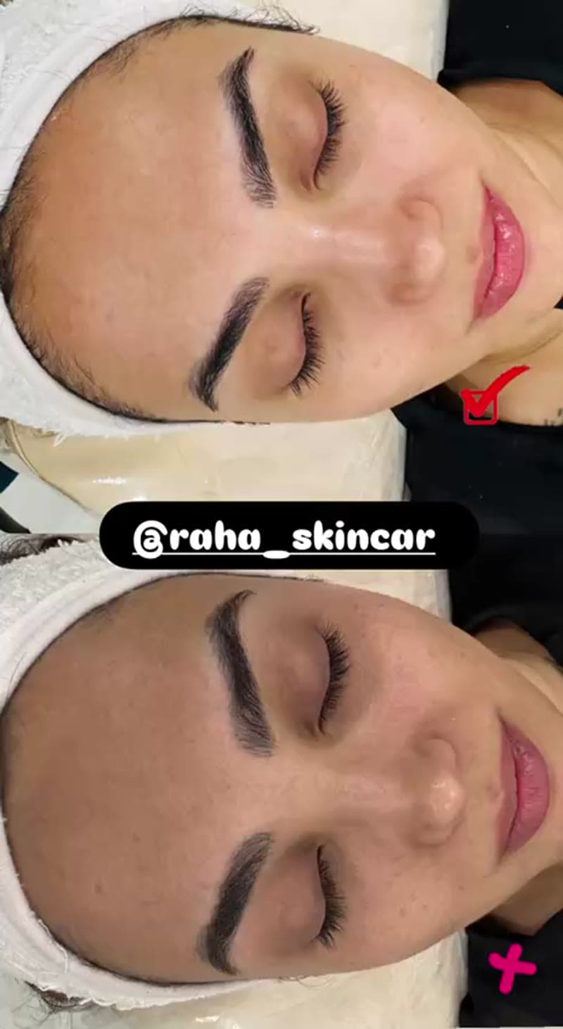نمونه کار پوست — فیشیال صورت ویدئو زنانه در یزد، یزد — فاطمه سروی