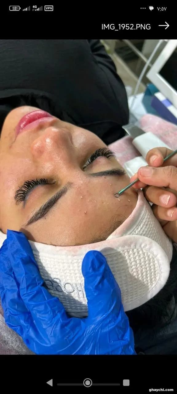 نمونه کار پوست — مراقبت از پوست مستعد جوش زنانه در قشم، قشم — مرضیه باغبانی