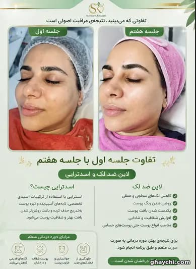 نمونه کار پوست — مراقبت از پوست لک‌دار زنانه در کارون شمالی، تهران — زینب خزایی