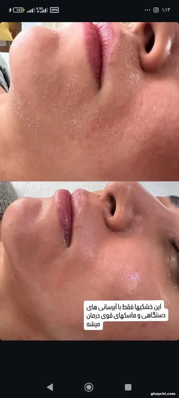 نمونه کار پوست — فیشیال صورت زنانه در سنندج، سنندج — کلینیک تخصصی پوست وموواسپا آرشا