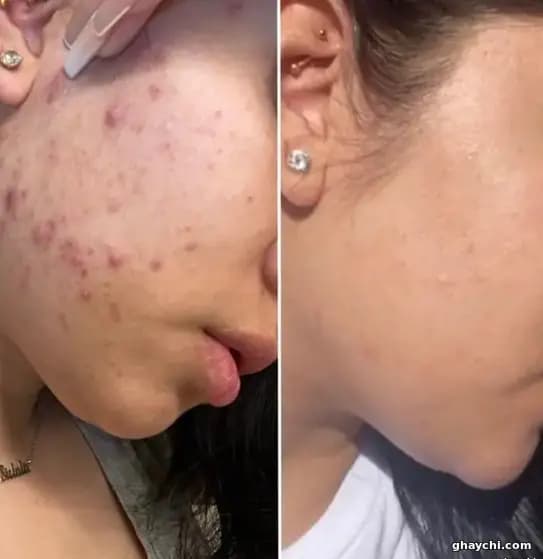 نمونه کار پوست — فیشیال صورت زنانه در بلوار سجاد، مشهد — سارا عمرانی