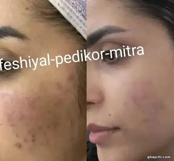 نمونه کار پوست — فیشیال صورت زنانه در تبریز، تبریز — میترا گوهرشناس