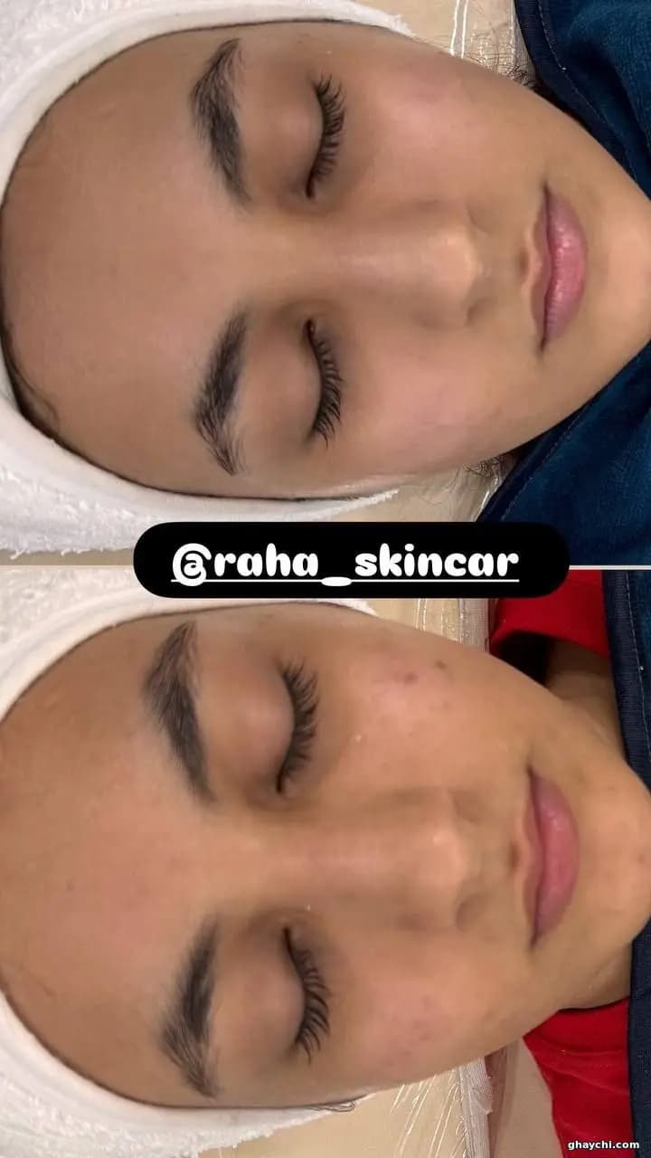 نمونه کار پوست — فیشیال صورت زنانه در یزد، یزد — فاطمه سروی
