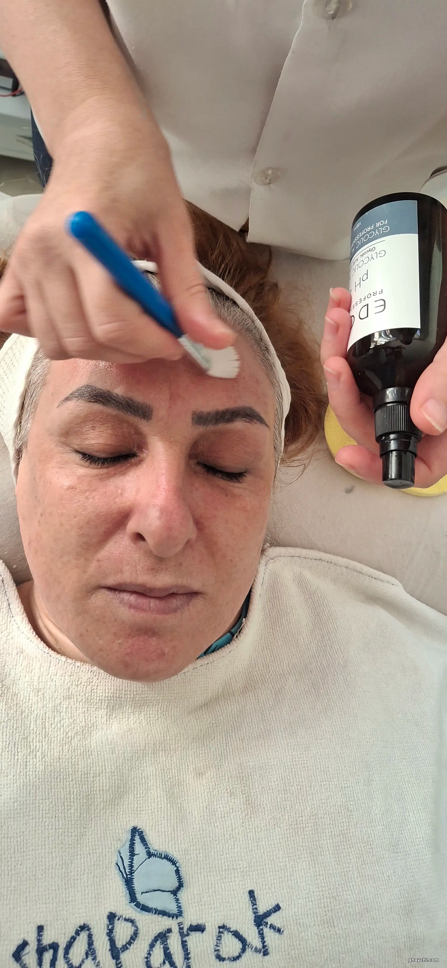 نمونه کار پوست — آبرسانی صورت قبل و بعد زنانه در اسلامشهر، اسلامشهر — کلینیک گل نرگس