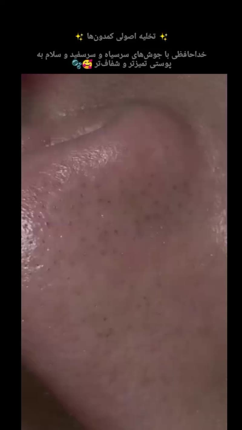 نمونه کار پوست — کلاژن سازی ویدئو زنانه در رشت، رشت — سکینه رجبی مقدم