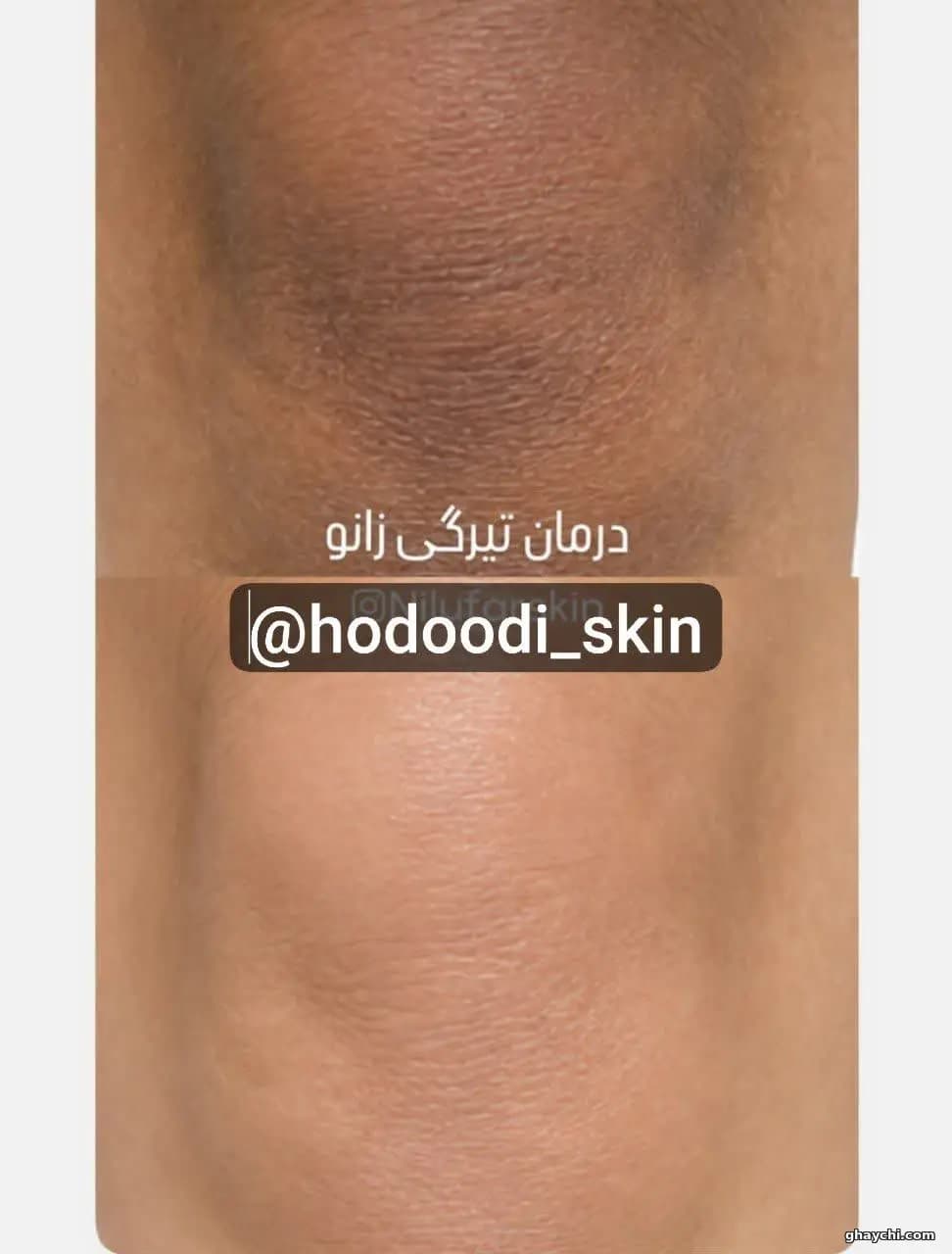نمونه کار پوست — فیشیال صورت زنانه در سنندج، سنندج — کلینیک تخصصی پوست وموواسپا آرشا