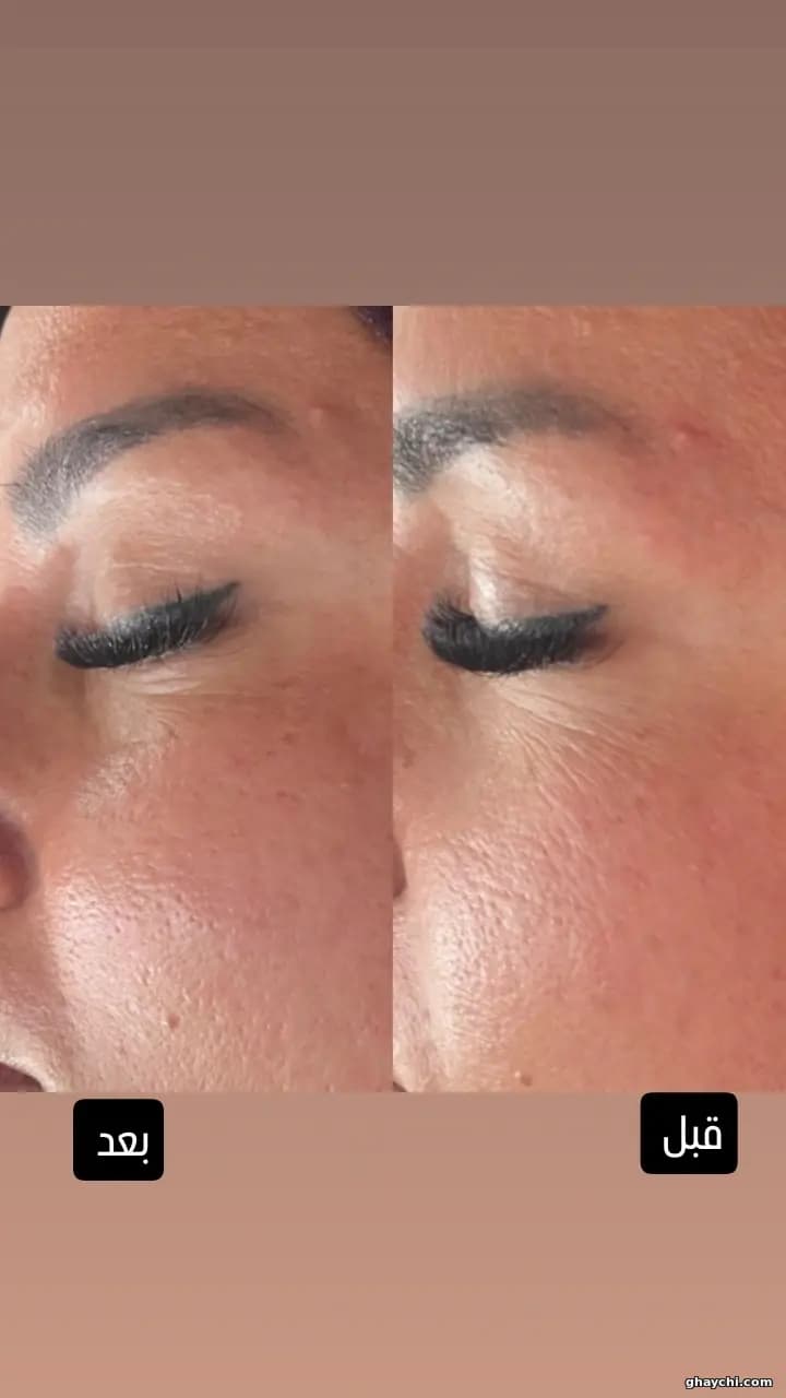 نمونه کار پوست — پاکسازی صورت قبل و بعد زنانه در مشکین دشت، مشکین دشت — سالن زیبایی بهار