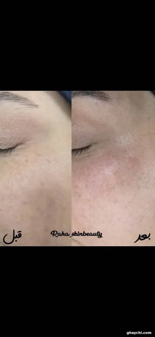 نمونه کار پوست — فیشیال صورت زنانه در یزد، یزد — فاطمه سروی