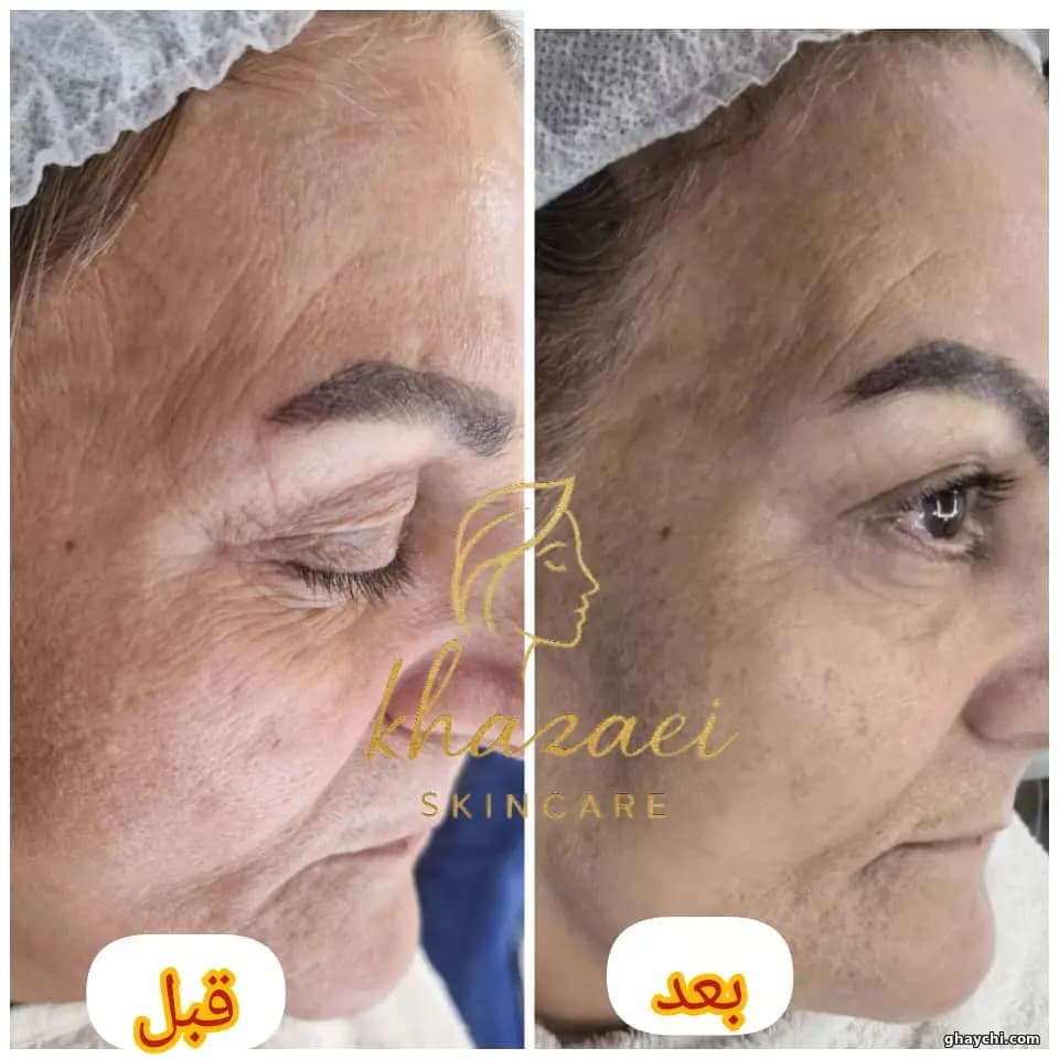 نمونه کار پوست — کلاژن سازی زنانه در کارون شمالی، تهران — زینب خزایی