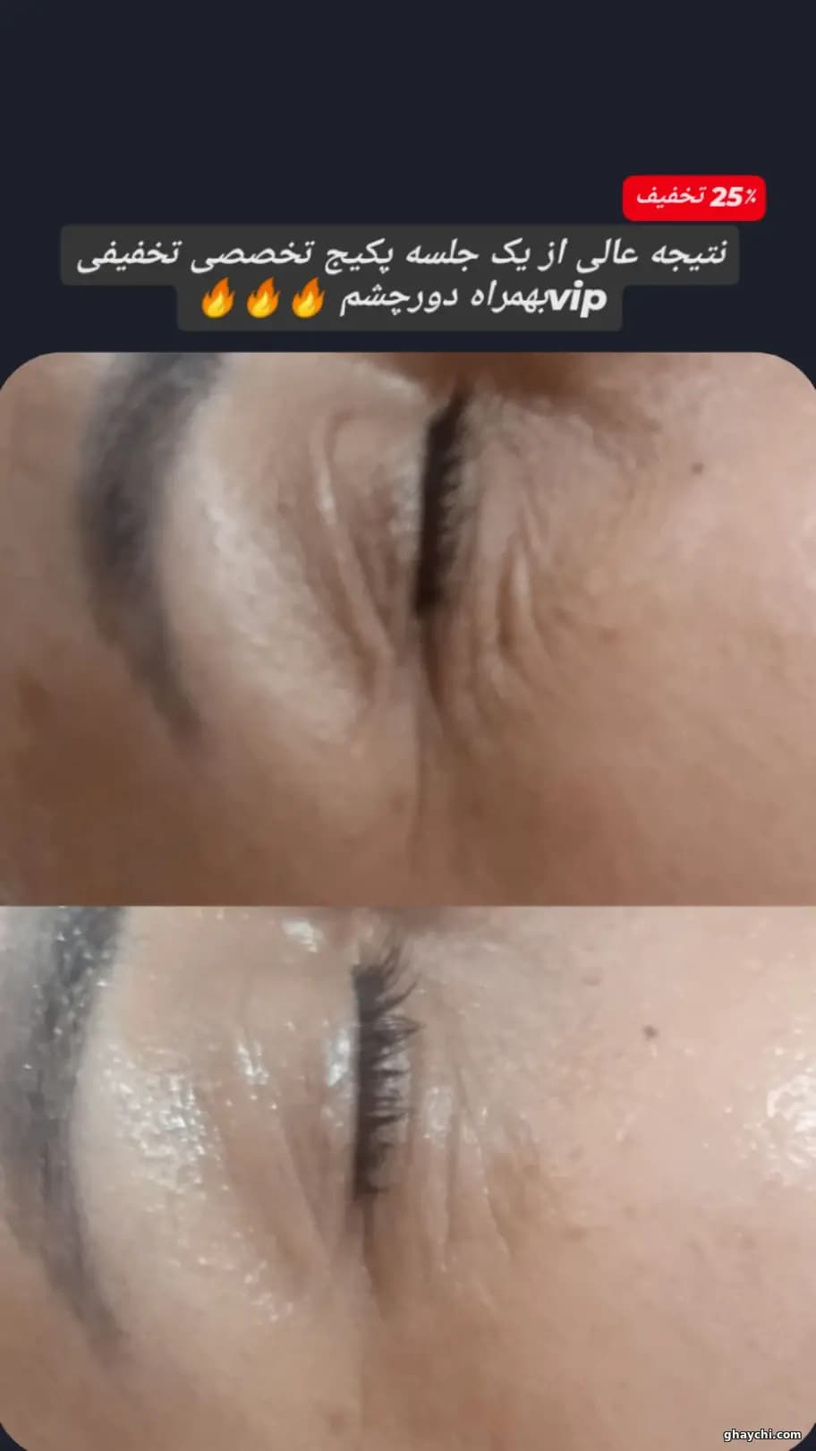 نمونه کار پوست — فیشیال صورت زنانه در رشت، رشت — سکینه رجبی مقدم