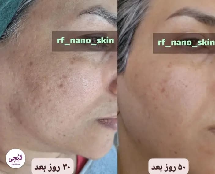 نمونه کار پوست — مراقبت از پوست لک‌دار زنانه در کرمان، کرمان — الی مومنی