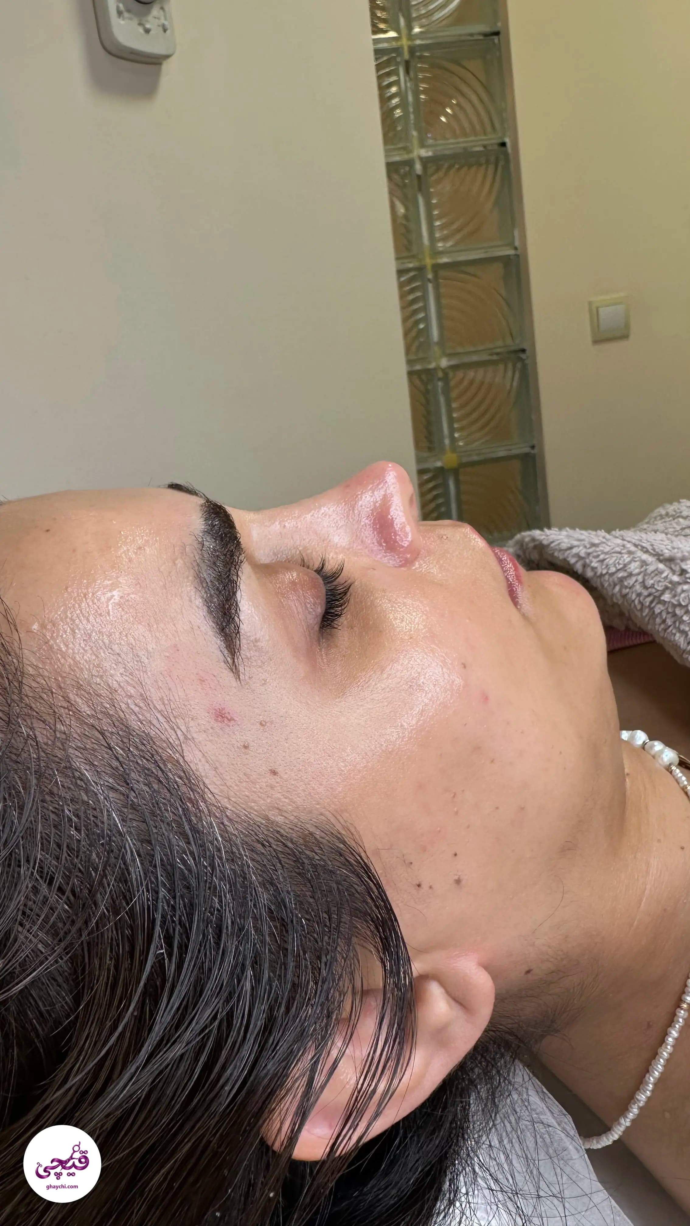 نمونه کار پوست — لایه برداری قبل و بعد زنانه در آمل، آمل — هانیه حسن پور