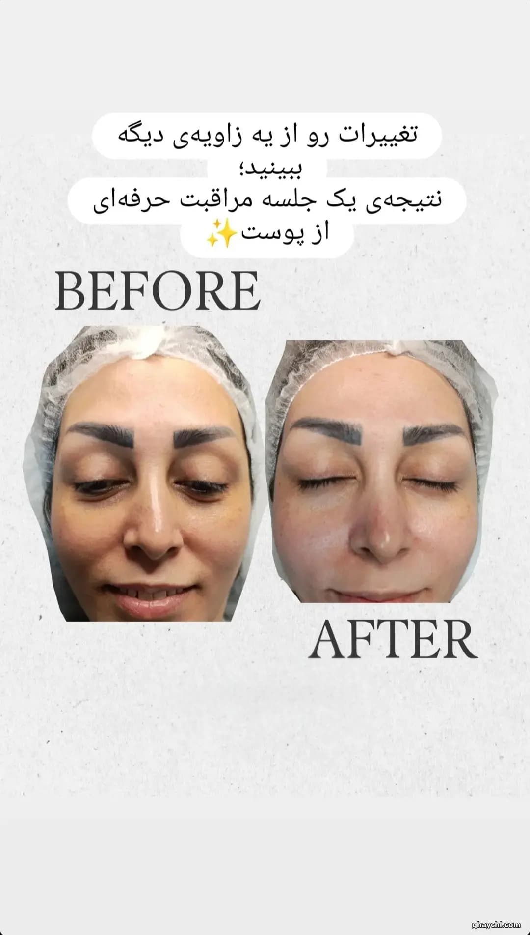 نمونه کار پوست — پاکسازی صورت زنانه در میدان انقلاب، تهران — سالن زیبایی سورله