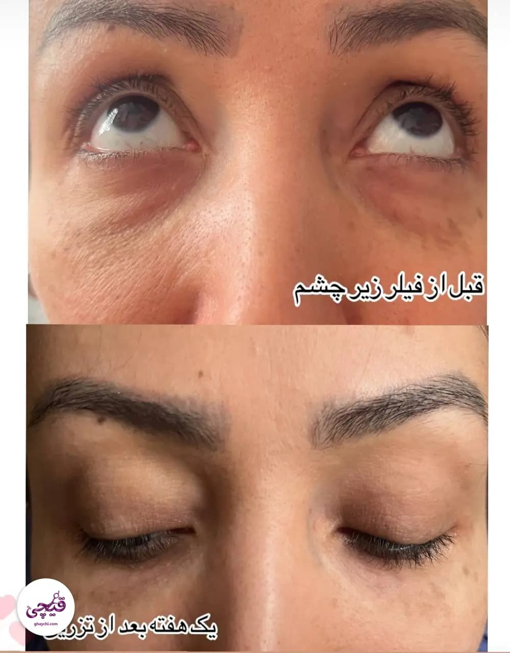 نمونه کار پوست — کلاژن سازی زنانه در هشتگرد، هشتگرد — مطب زیبایی
