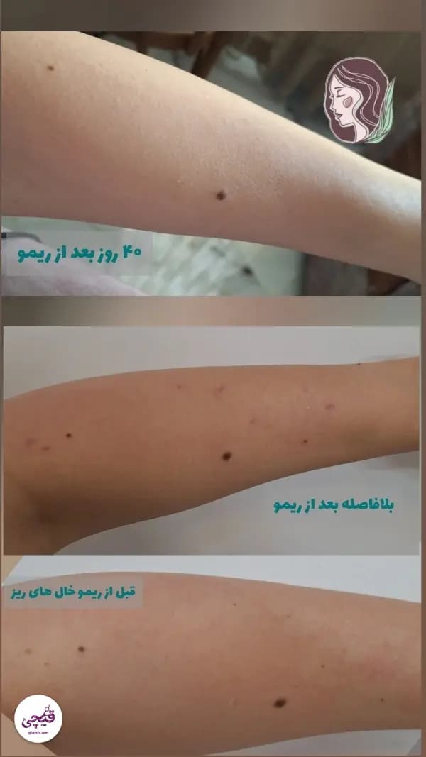 نمونه کار پوست — مراقبت از پوست لک‌دار زنانه در کرمان، کرمان — الی مومنی