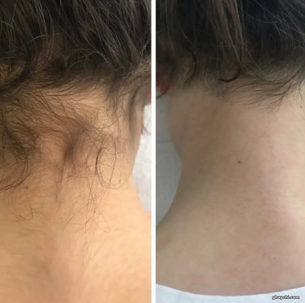 نمونه کار پوست — پاکسازی صورت قبل و بعد زنانه در خیابان ستارخان، تهران — فیت آرا