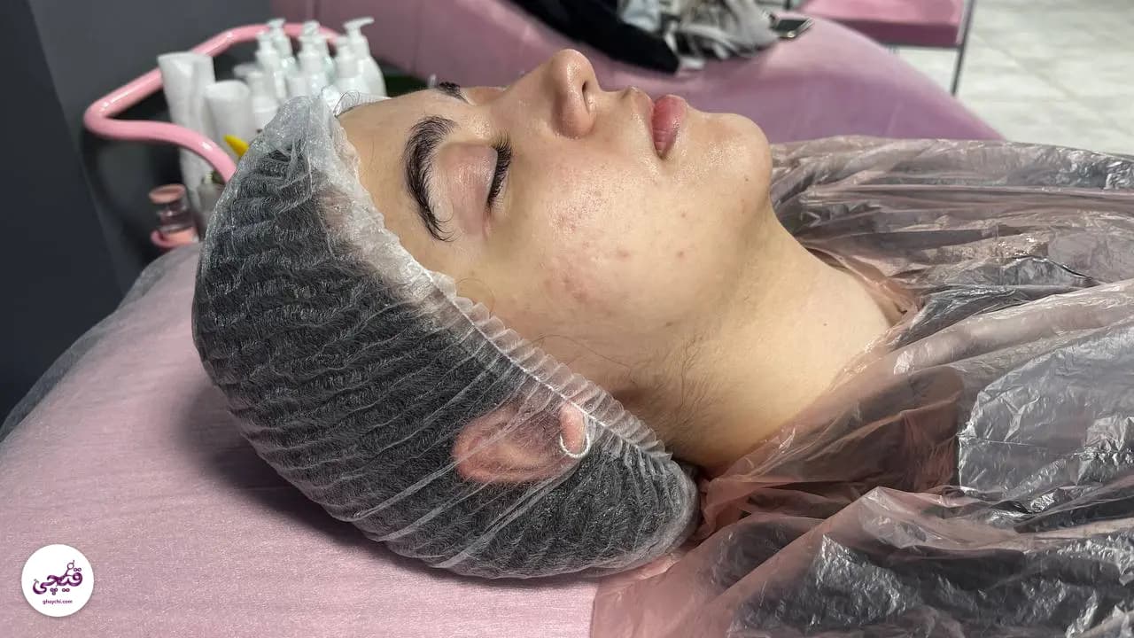 نمونه کار پوست — فیشیال صورت قبل و بعد زنانه در کرج — تارا امینی ثابت
