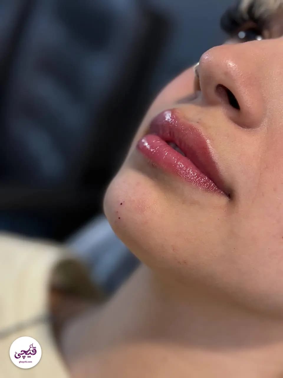 نمونه کار پوست — کلاژن سازی زنانه در هشتگرد، هشتگرد — مطب زیبایی