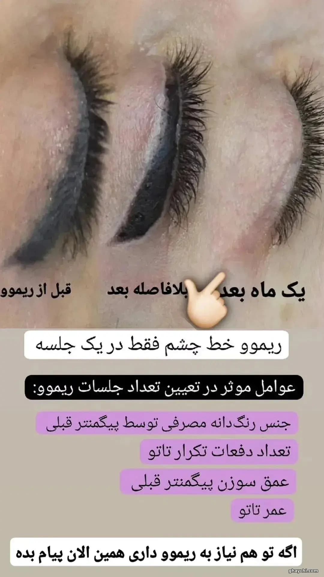 نمونه کار آرایش دائم — ریمووال زنانه در گرگان، گرگان — نرگس مقدری