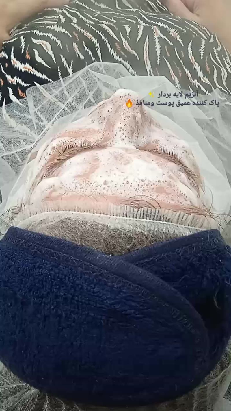 نمونه کار پوست — کلاژن سازی ویدئو زنانه در رشت، رشت — سکینه رجبی مقدم