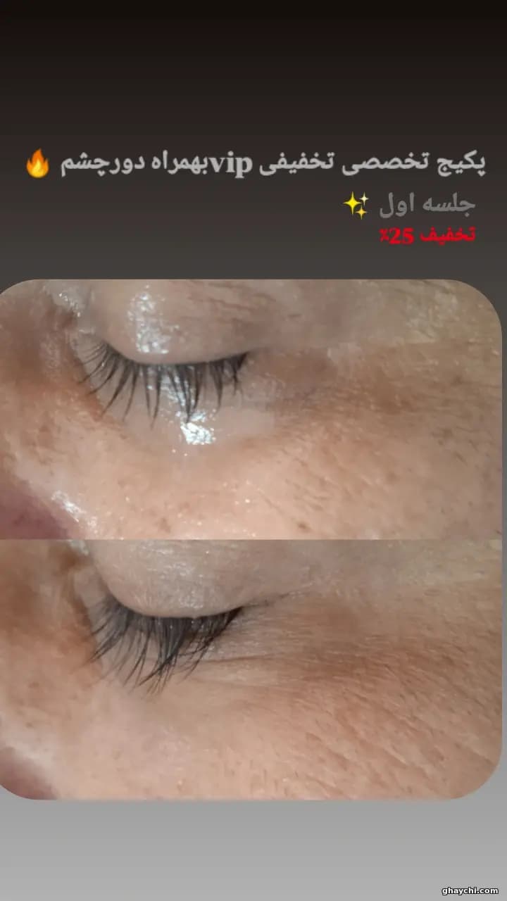 نمونه کار پوست — فیشیال دور چشم زنانه در رشت، رشت — سکینه رجبی مقدم