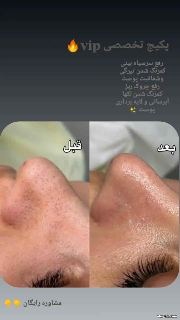 نمونه کار پوست — کلاژن سازی زنانه در رشت، رشت — سکینه رجبی مقدم