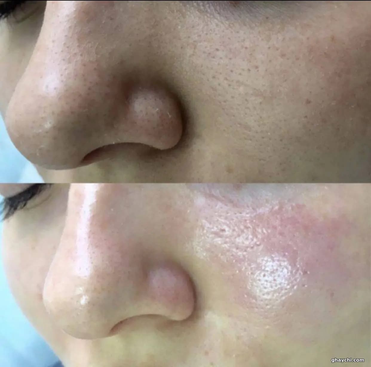 نمونه کار پوست — پاکسازی صورت زنانه در رشت، رشت — الهه ناز