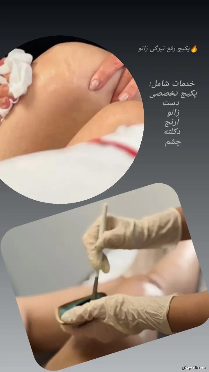 نمونه کار پوست — کلاژن سازی زنانه در رشت، رشت — سکینه رجبی مقدم