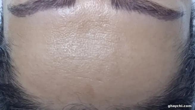 نمونه کار پوست — کلاژن سازی قبل و بعد زنانه در رشت، رشت — سکینه رجبی مقدم