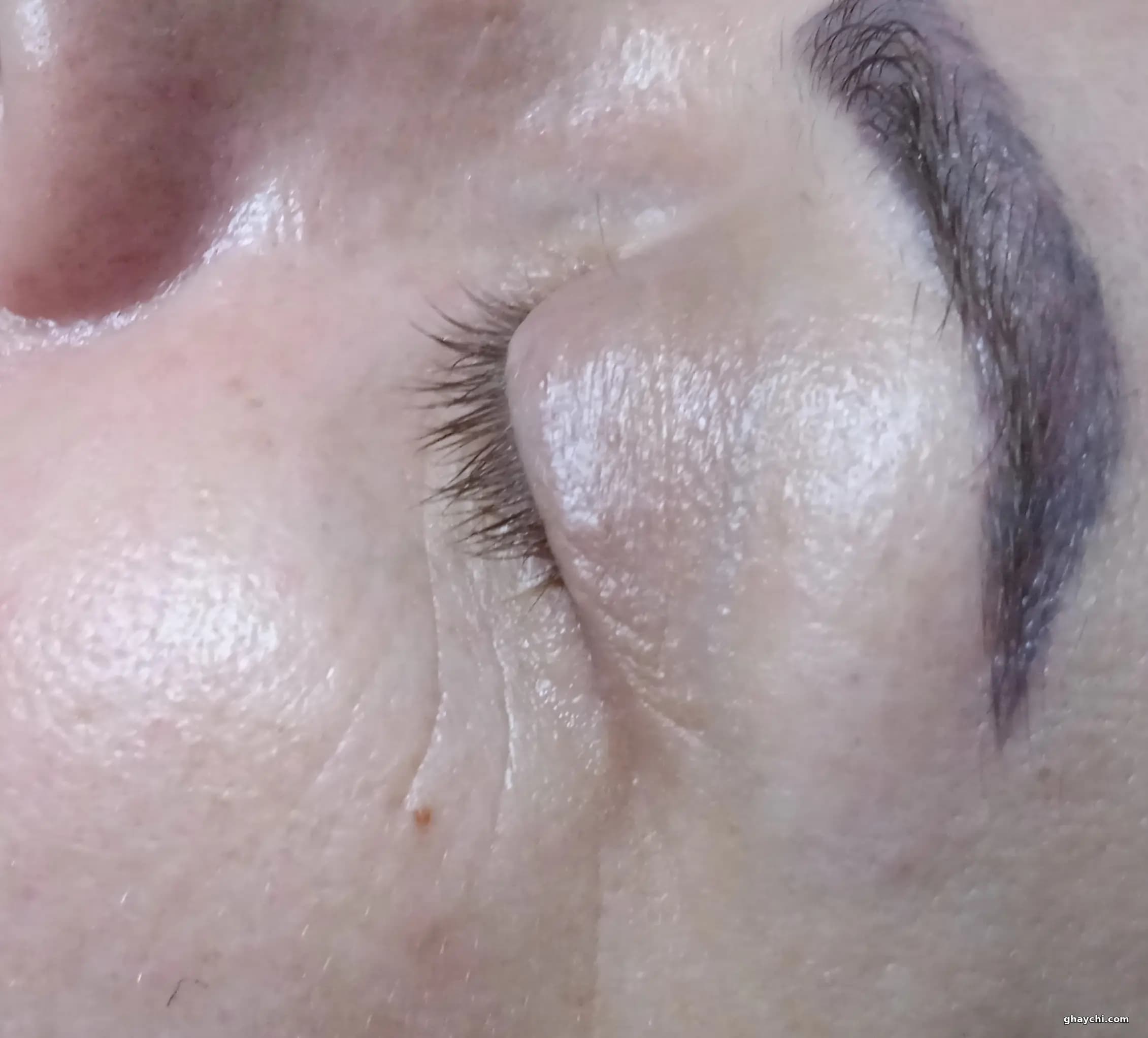 نمونه کار پوست — فیشیال دور چشم قبل و بعد زنانه در رشت، رشت — سکینه رجبی مقدم