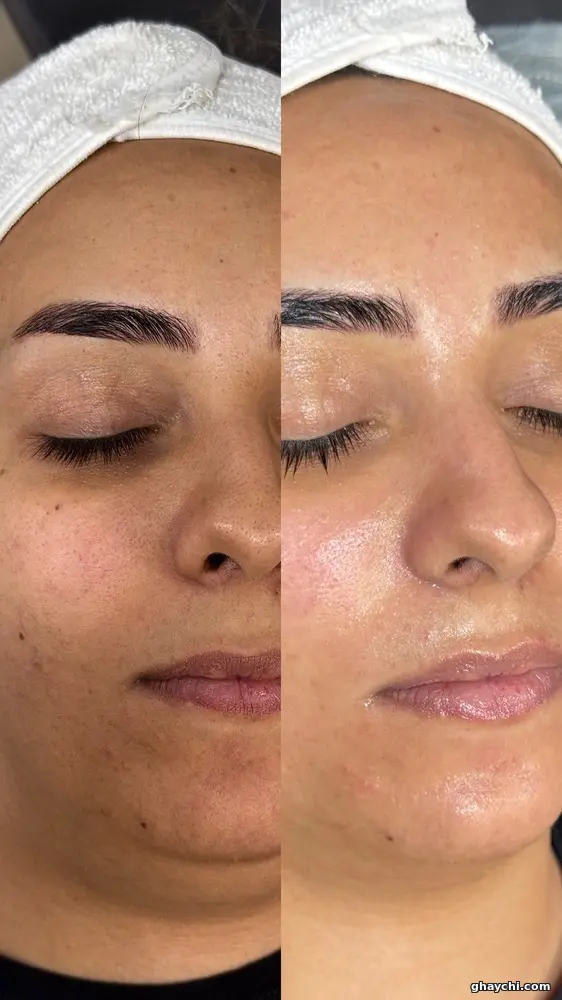نمونه کار پوست — فیشیال صورت زنانه در سعادت آباد، تهران — سحر رضایی