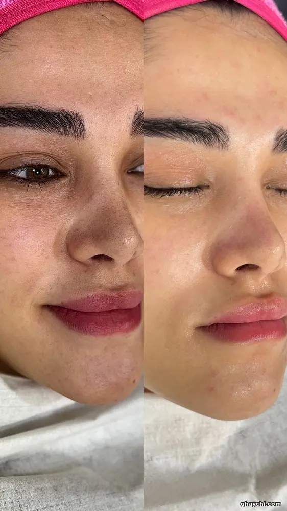 نمونه کار پوست — فیشیال صورت زنانه در سعادت آباد، تهران — سحر رضایی