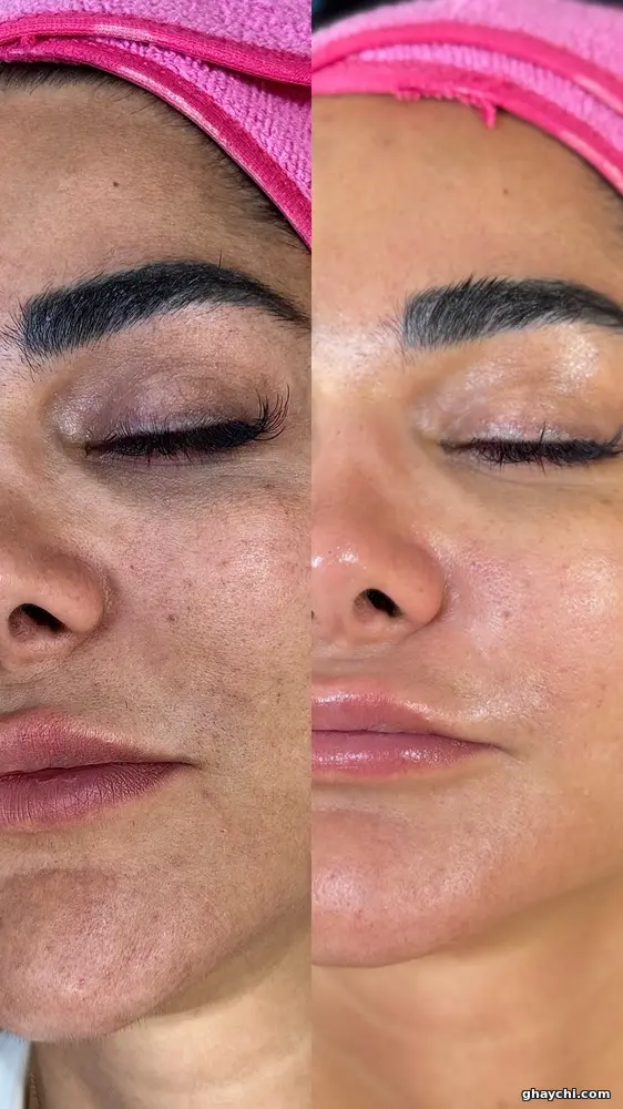نمونه کار پوست — کلاژن سازی زنانه در سعادت آباد، تهران — سحر رضایی