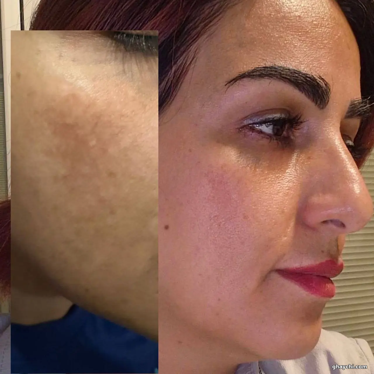 نمونه کار پوست — فیشیال صورت زنانه در شهرک غرب، تهران — پینورالوکس