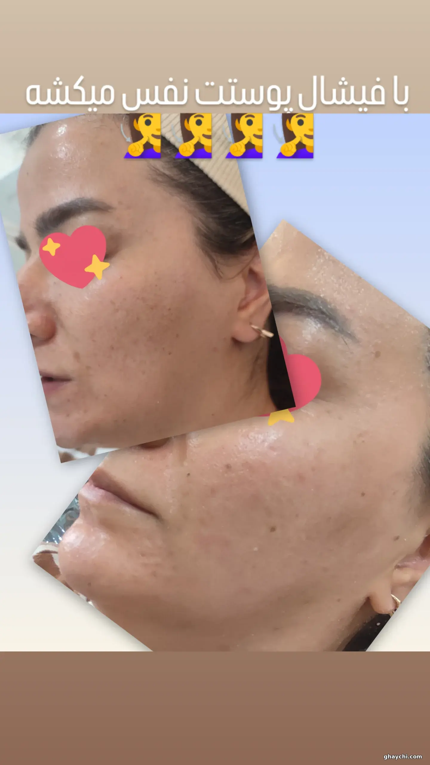 قبل پوست — فیشیال صورت در آبرسان، تبریز — فاطمه عیوضی