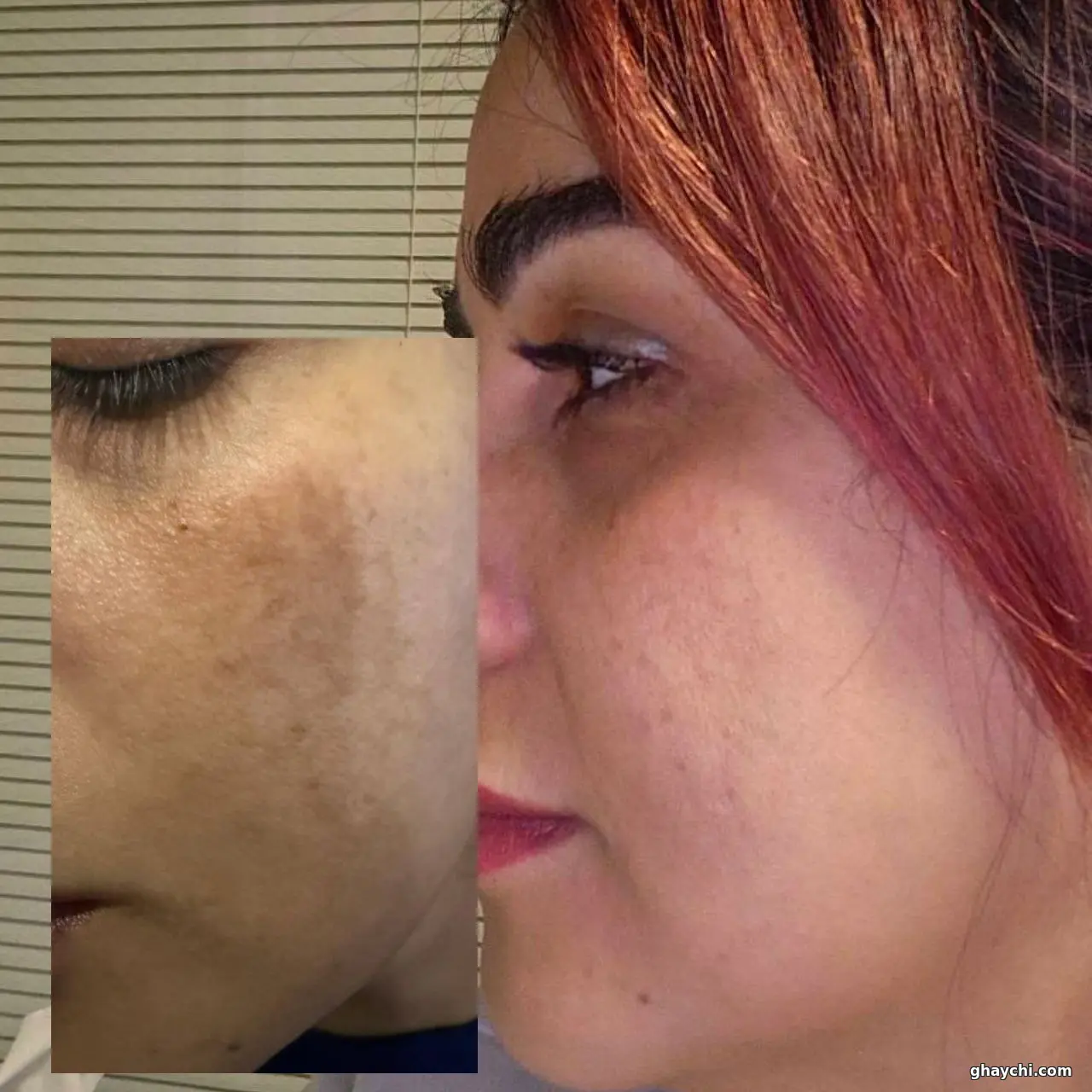 نمونه کار پوست — فیشیال صورت زنانه در شهرک غرب، تهران — پینورالوکس