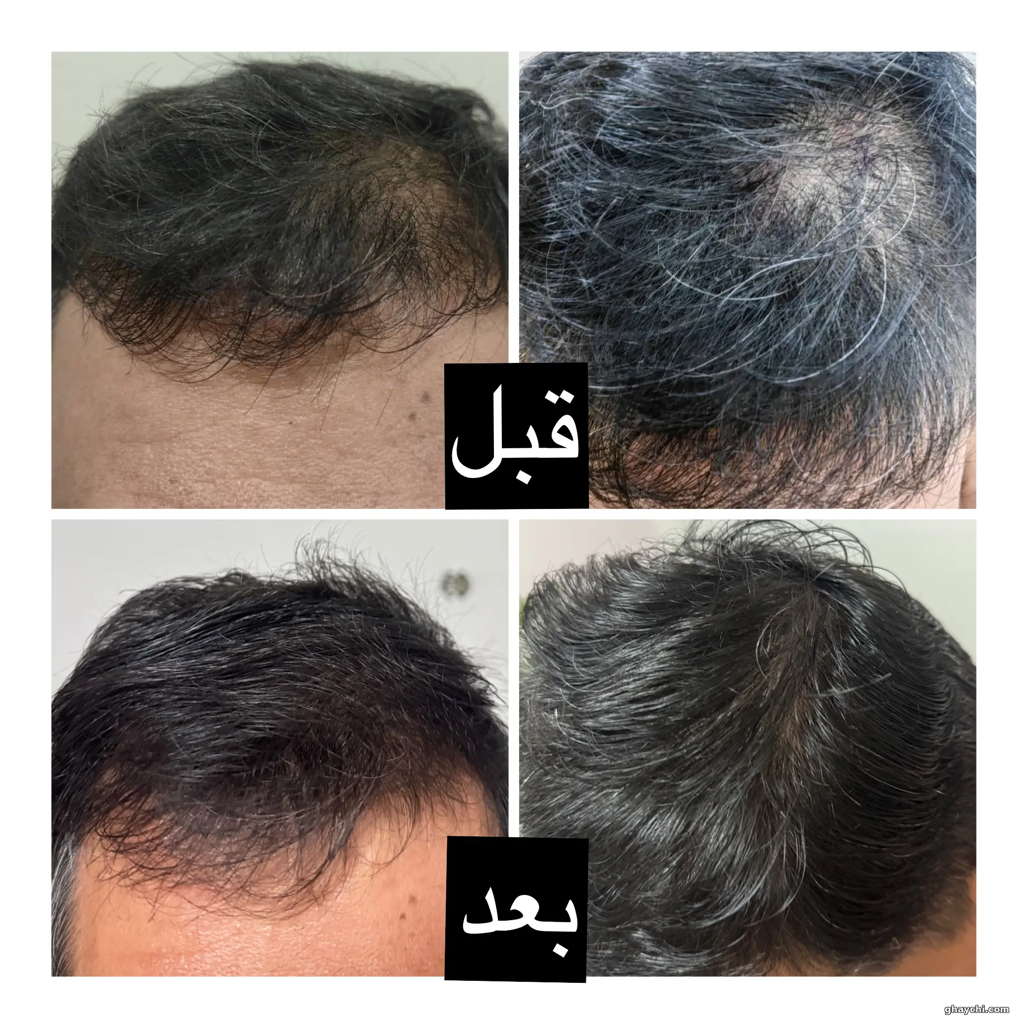 نمونه کار مو — بوتاکس و احیا مو زنانه در دوم صادقیه، تهران — سپیده سرپاک