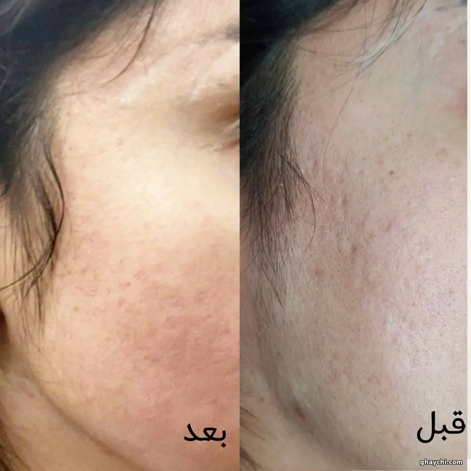 نمونه کار پوست — فیشیال صورت زنانه در شهرک غرب، تهران — پینورالوکس