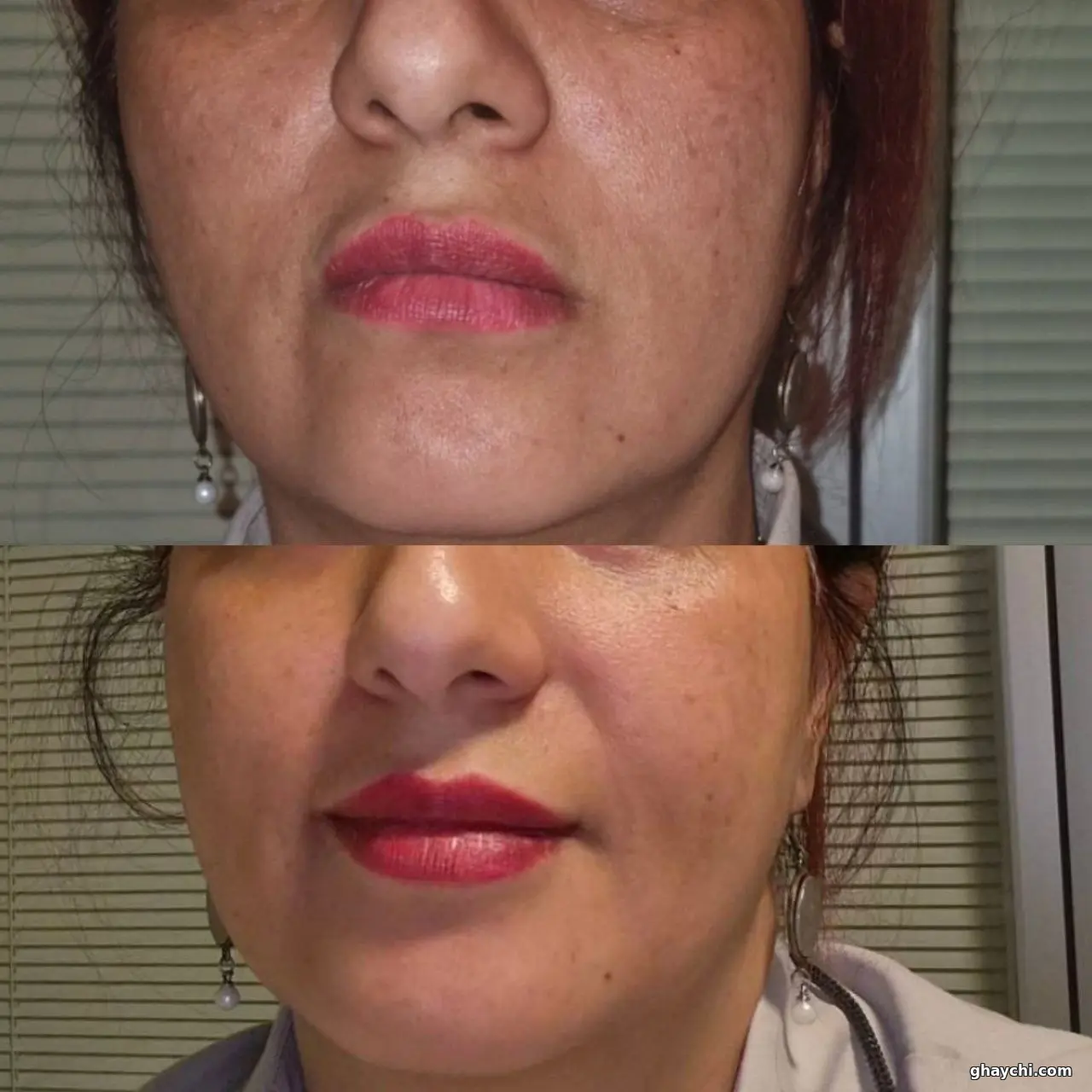 نمونه کار پوست — فیشیال صورت زنانه در شهرک غرب، تهران — پینورالوکس