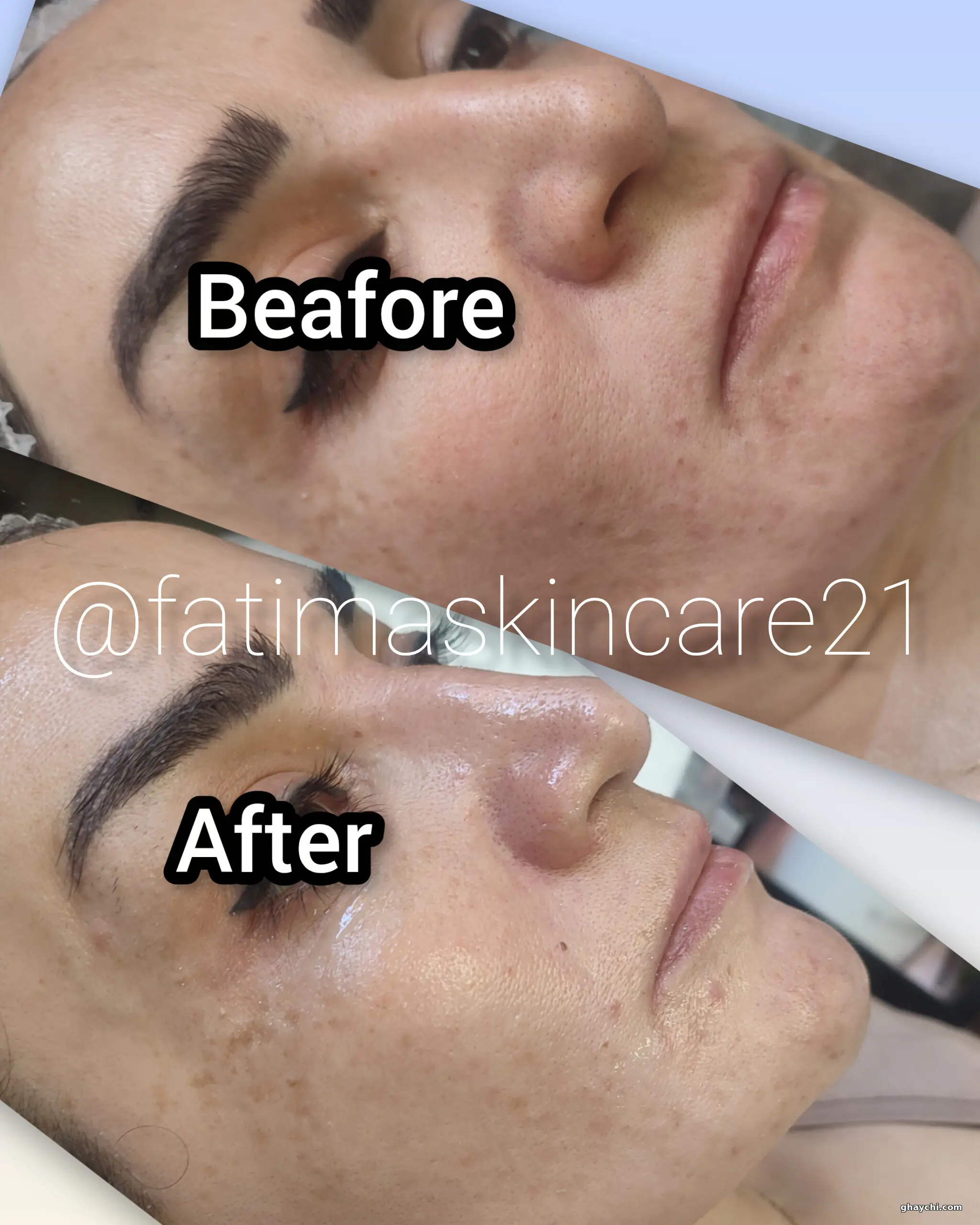 بعد پوست — فیشیال صورت در آبرسان، تبریز — فاطمه عیوضی