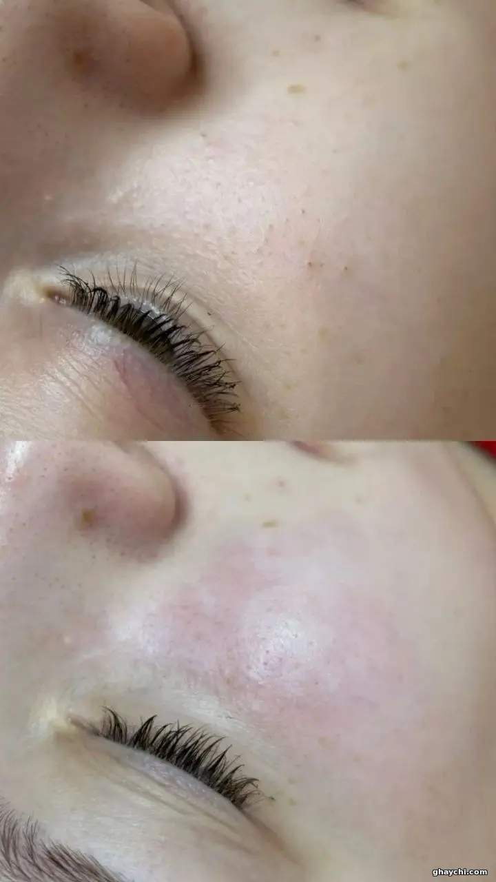 نمونه کار پوست — پاکسازی صورت زنانه در  بلوار معالی آباد، شیراز — فرزانه جعفری