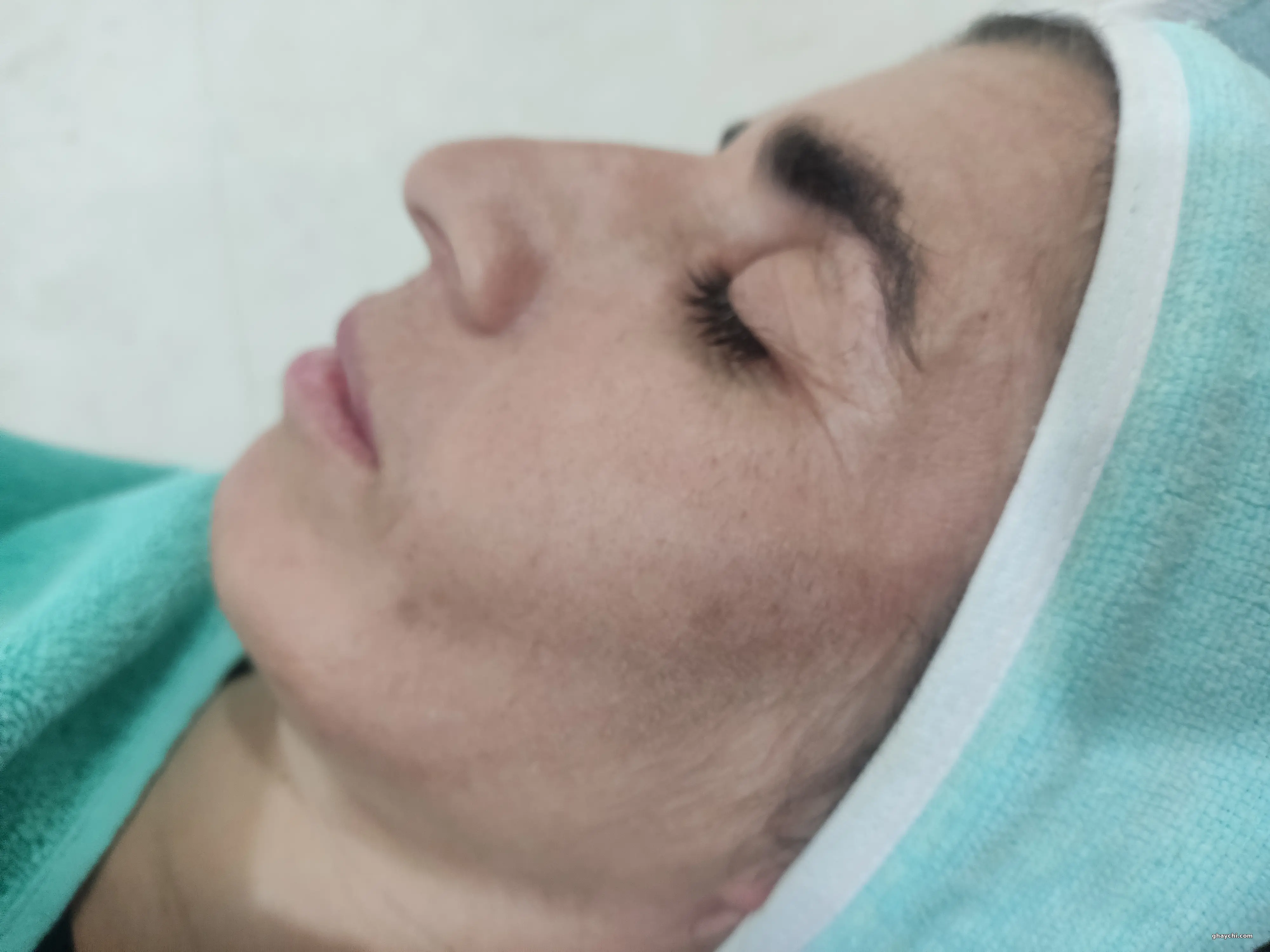 قبل پوست — آبرسانی صورت در  بلوار سفیر، شیراز — مرضیه حیاتی