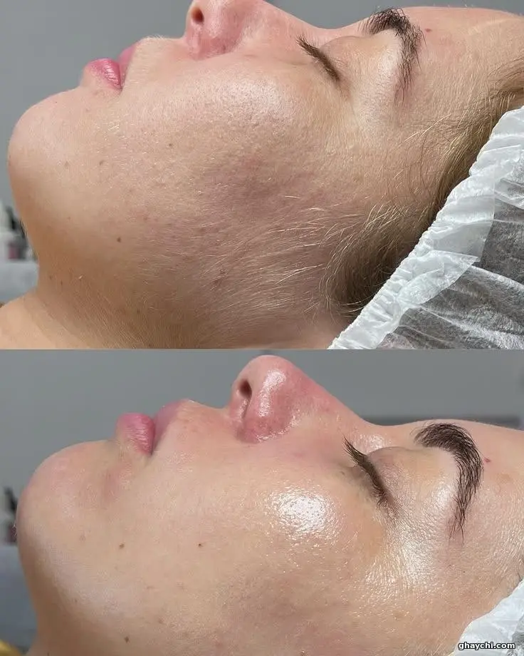 نمونه کار پوست — فیشیال صورت زنانه در  بلوار معالی آباد، شیراز — فرزانه جعفری