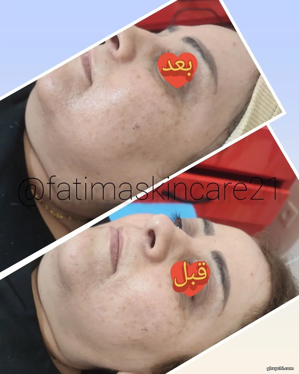 نمونه کار پوست — فیشیال صورت زنانه در آبرسان، تبریز — فاطمه عیوضی